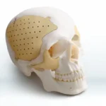 Система восстановления черепно-челюстно-лицевой поверхности Recranio TM